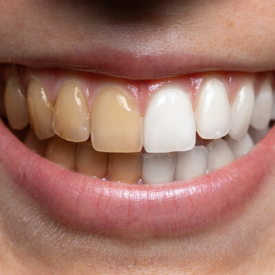 4 Home Remedies for Whiter Teeth