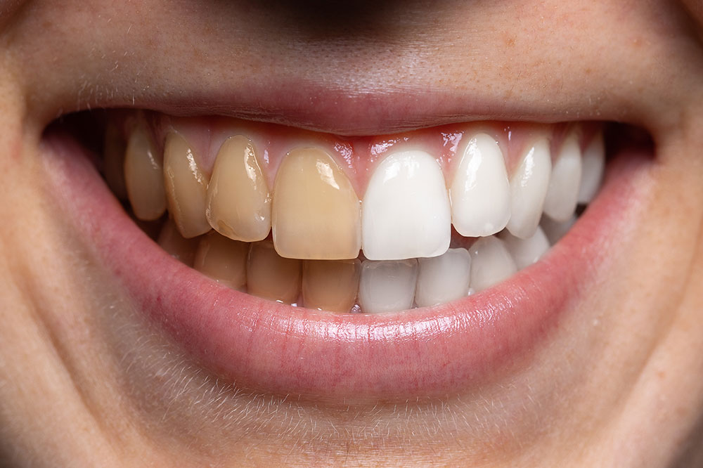 4 Home Remedies for Whiter Teeth