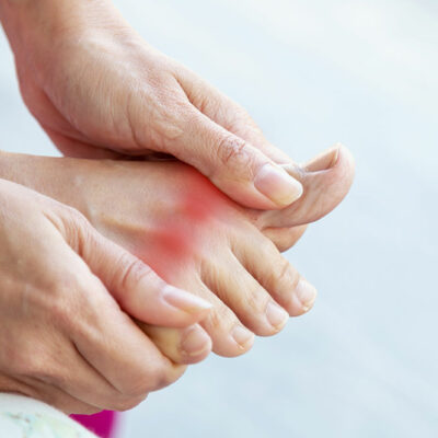 6 Lifestyle Tips for Gout