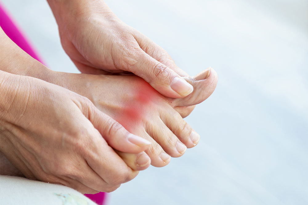 6 Lifestyle Tips for Gout