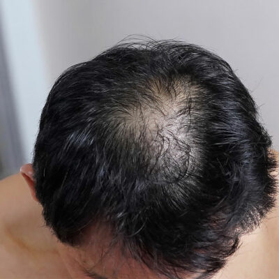 6 Tips to Prevent Male Pattern Baldness