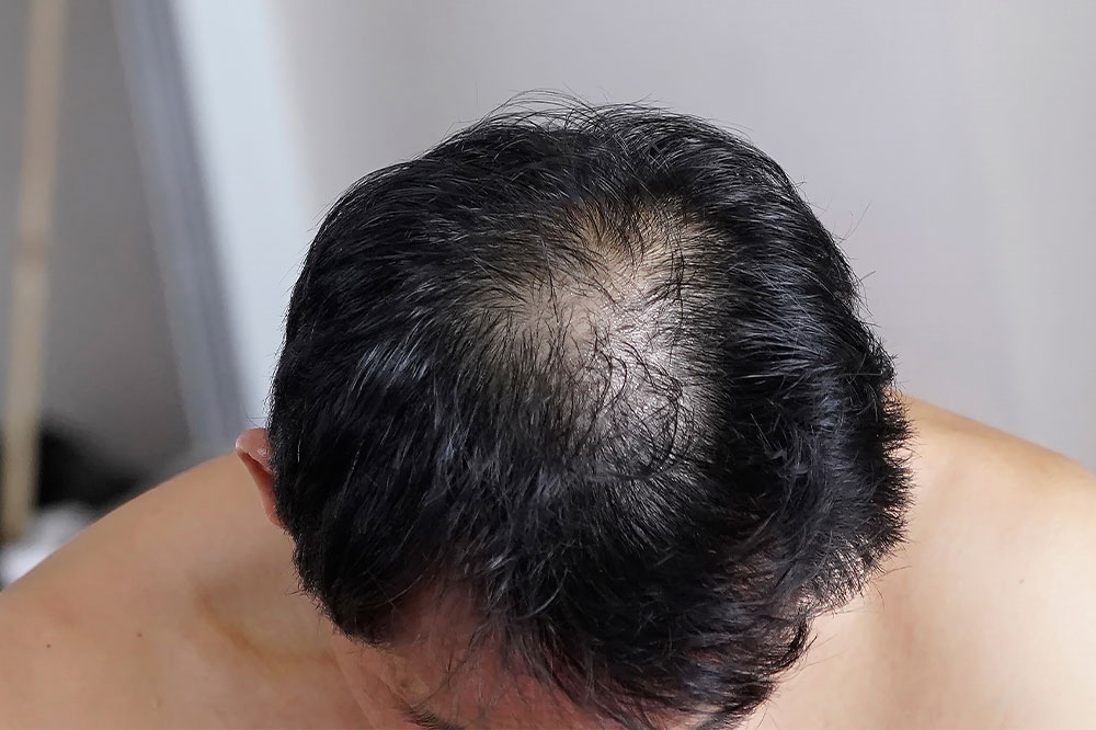 6 Tips to Prevent Male Pattern Baldness