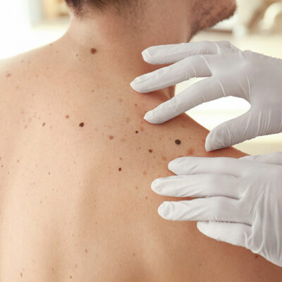 8 Common Melanoma Complications