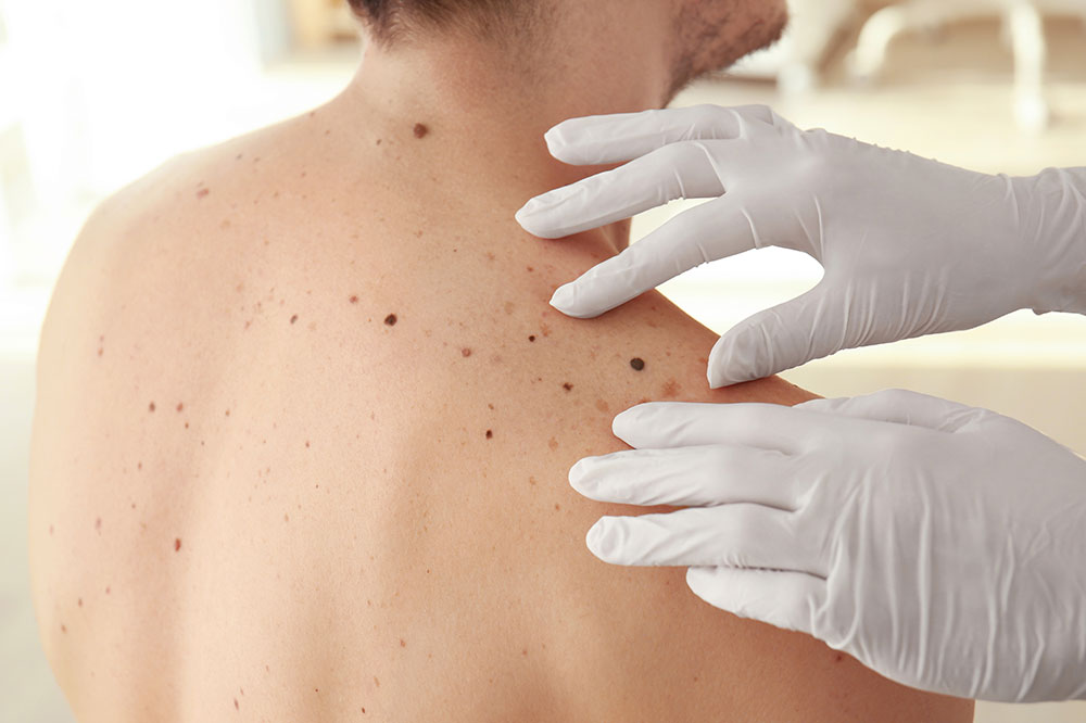 8 Common Melanoma Complications