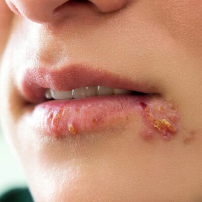 Treatment Options for Cold Sores