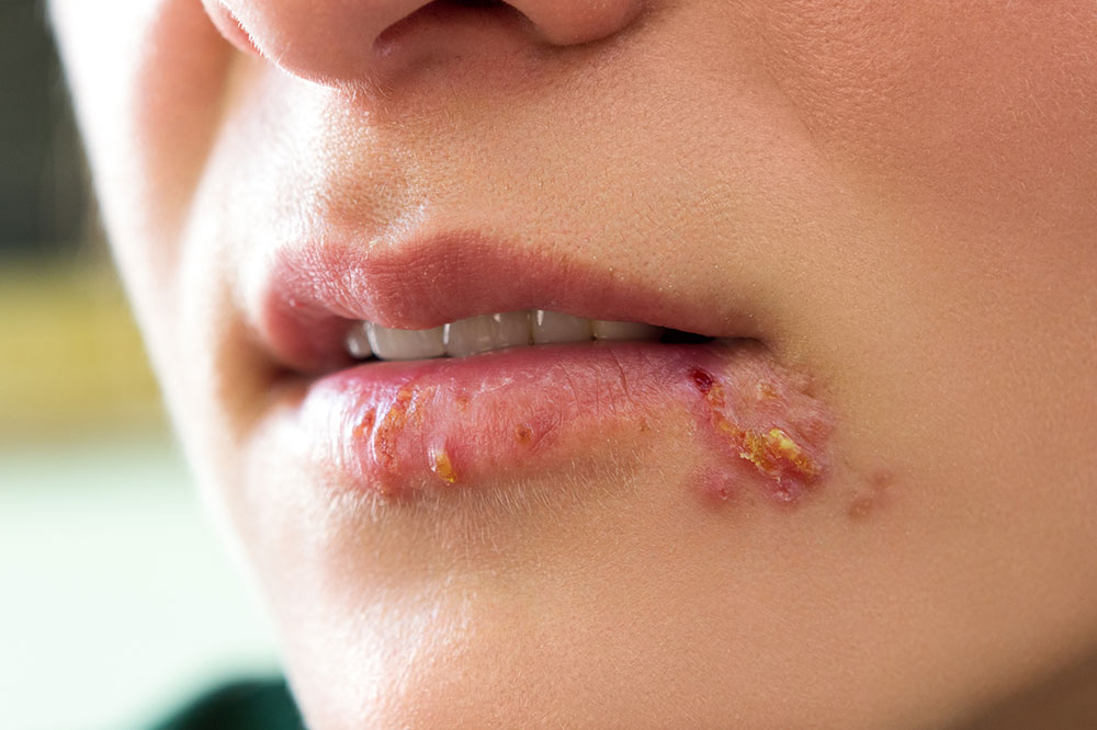 Treatment Options for Cold Sores