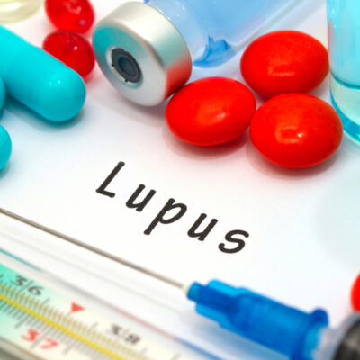 3 Major Risk Factors of Lupus